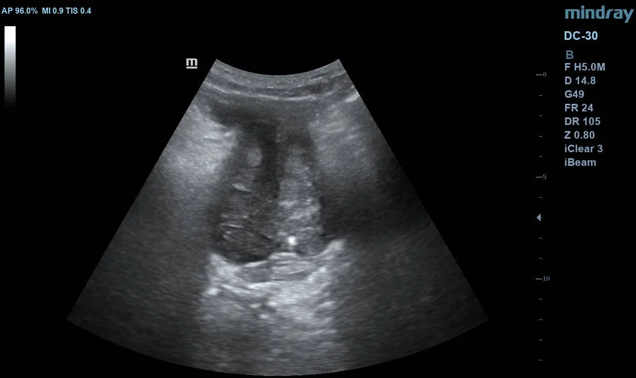 Transverse pelvic ultrasound showing markedly enlarged prostate with heterogeneous echotexture.