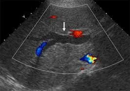 RPC ductal dilatation
