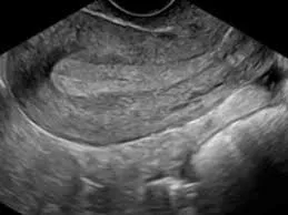 Secretory phase