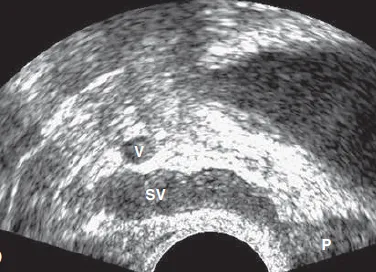 Normal seminal vesicles