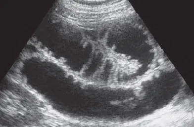 Small Bowel Obstruction