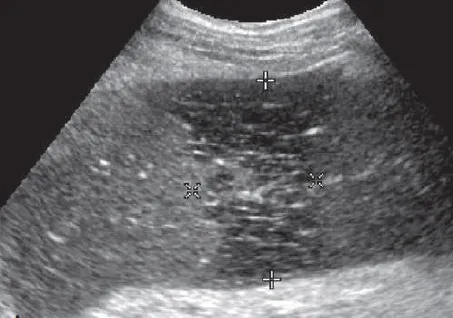 Splenic infarct