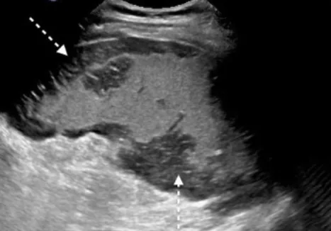 Splenic sequestration ultrasound