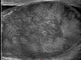 Testicular torsion