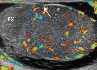 Testicular trauma