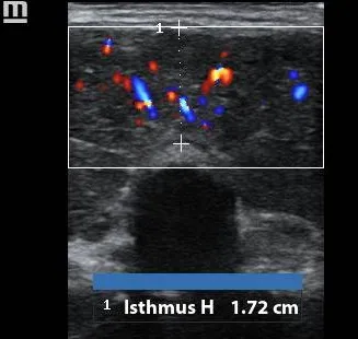 Thyroiditis isthmus thickening ultrasound
