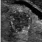 Malignant thyroid nodule
