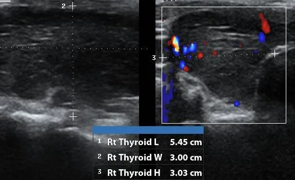 Hashimoto's Thyroiditis right lobe ultrasound